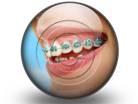 Orthodontic Braces S PPT PowerPoint Image Picture